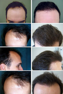 Hair Restoration