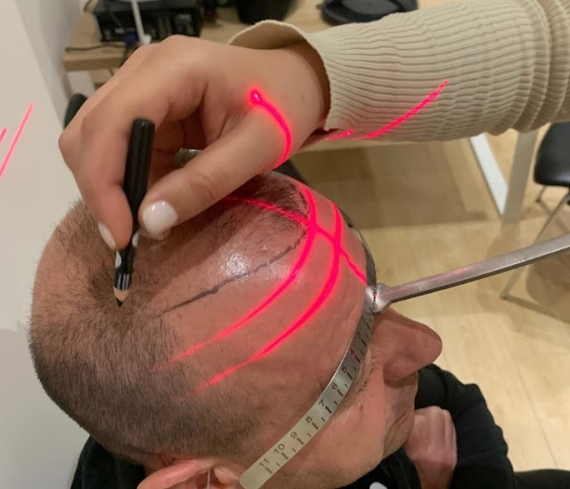 Turkish trichologist measuring the baldness areas of a patient in Tirana with ruler and laser for maximum care quality
