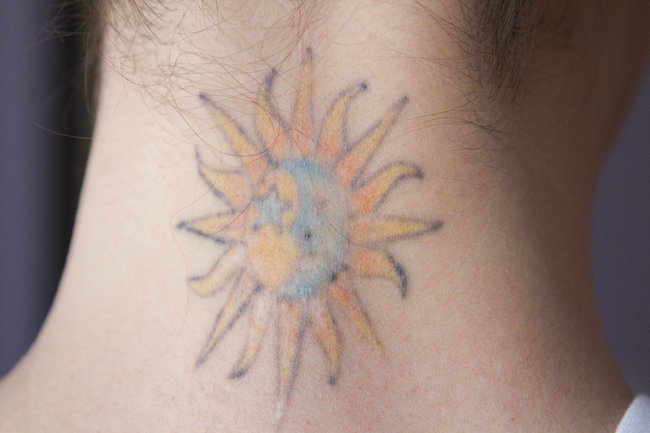 My destroyed tattoo after 3 or 4 removal treatments