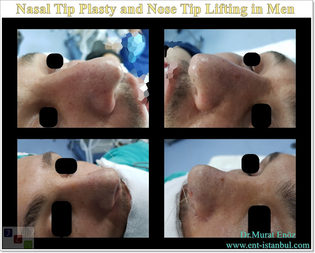 Droopy nose tip - Nasal tip plasty in men istanbul
