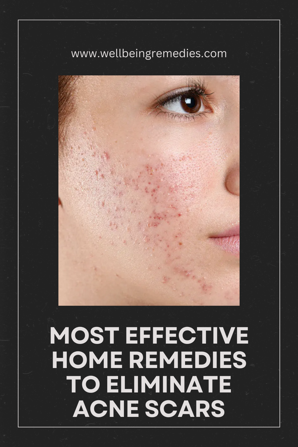 Most Effective Home Remedies to Eliminate Acne Scars