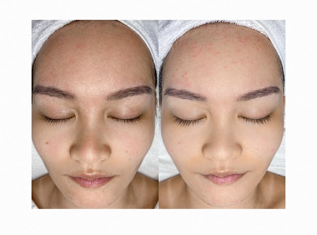 new-york-skin-solutions-activ-clear-acne-review