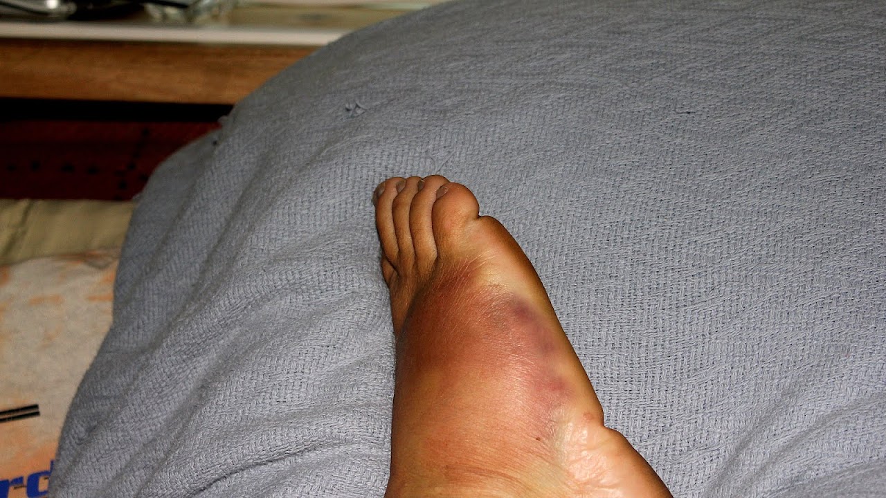 Foot Injuries Running Injury