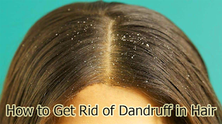 How to Get Rid of Dandruff in Hair