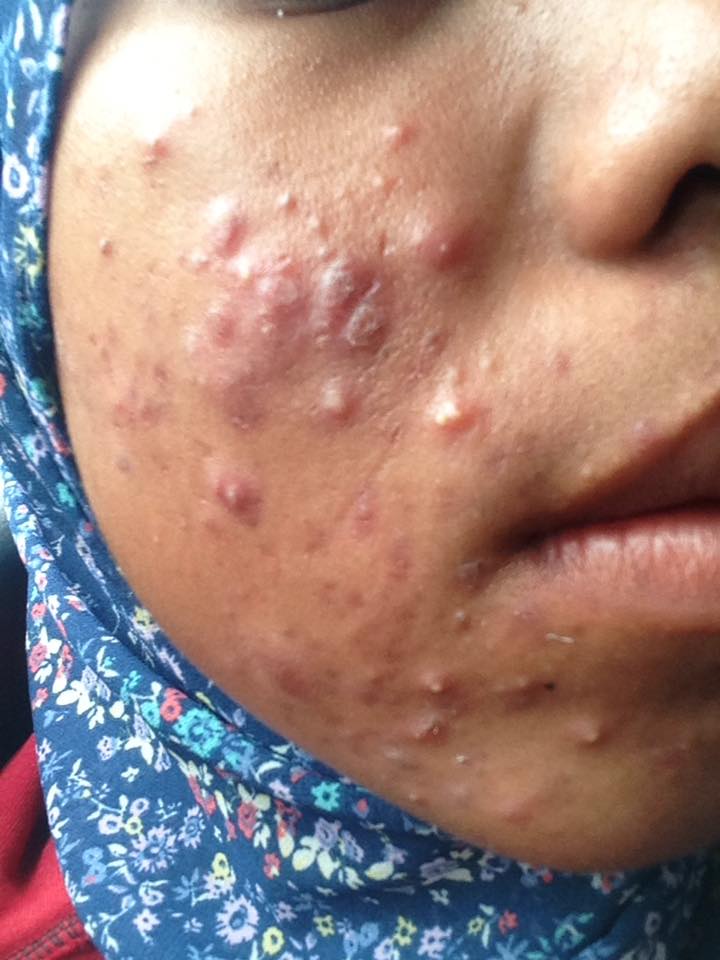 Review : Dalacin T Ubat Jerawat Paling Viral - OMBAKBERGIGI