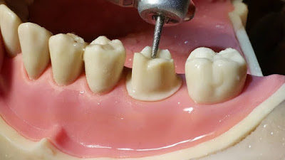 Bọc răng sứ có hại hay không-2