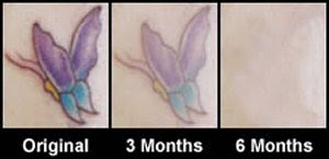 Tattoo Removal