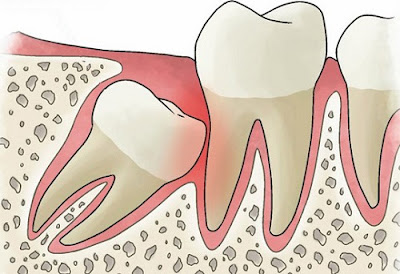 Nguyên nhân răng khôn mọc lệch gây đau