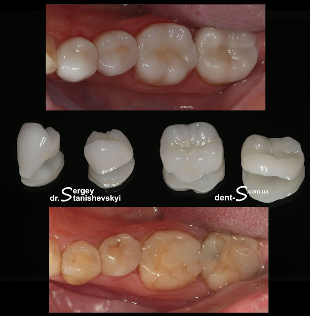 стоматолог стоматология Виниры Киев Станишевский Сергей накладки коронки керамика керамическая реставрации вкладки e-max inlay onlay overlay veneer veneers