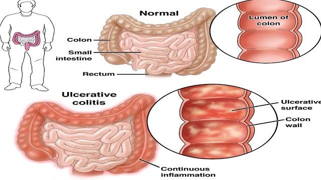 https://www.healthandfitnessexpert.in/2024/03/ulcerative-colitis-symptoms-and-causes.html