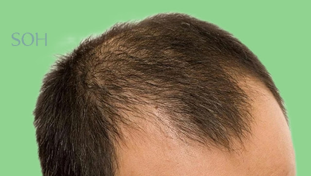 Understanding Hair Loss: Exploring Common Illnesses as Culprits