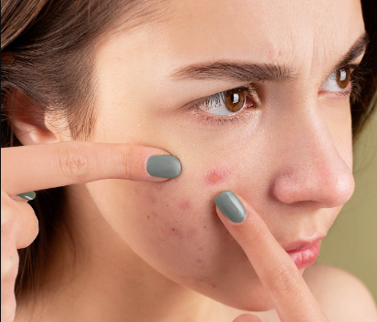 ways to get rid of red acne scars