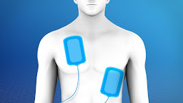 https://www.hopkinsmedicine.org/health/treatment-tests-and-therapies/electrical-cardioversion