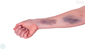 Bruise,কালশিরে