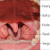 Fluid Volume Deficit related to Tonsillitis