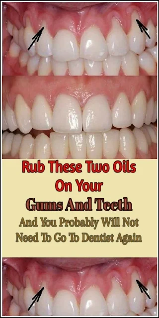 Rub These Two Oils On Your Gums And Teeth And You Probably Will Not Need To Go To Dentist Again