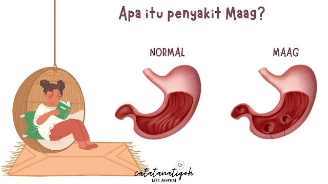 apa itu maag