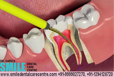 Painless Root canal Treatment