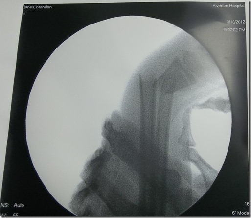 brandon's broken arm 075