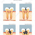 Dental Caries