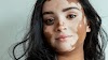 What Is Vitiligo?Symptoms,Causes And Treatment Of Vtiligo||Trends Home
