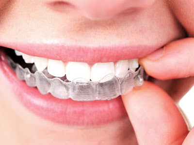 Invisalign straightening your teeth