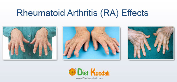 Rheumatoid arthritis-(RA)-Effects-on hands-DietKundali.com