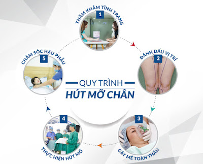 Hút mỡ thu gọn bắp chân 