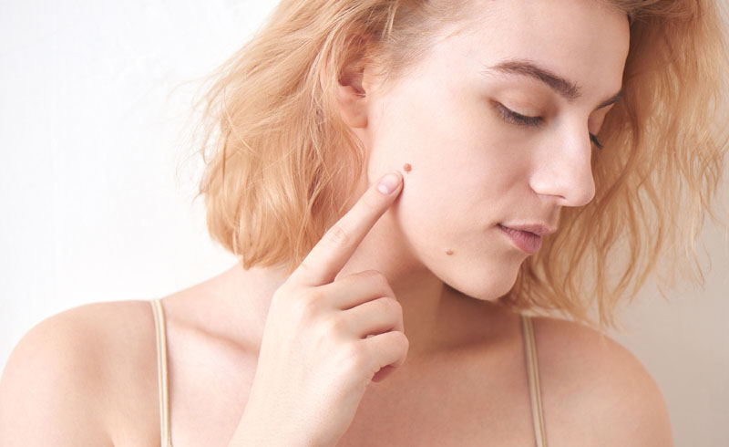  13 Weird Skin Spots You Should Definitely Get Checked Out