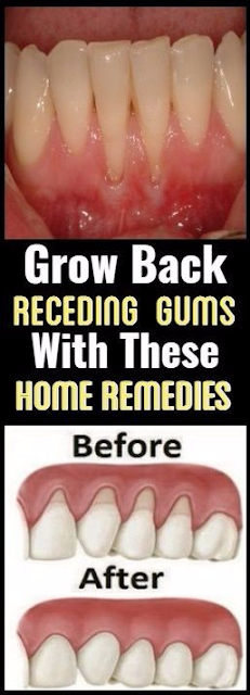 Grow Back Your Receding Gums With These Natural Remedies !