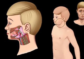 Mumps Or Parotitis Disease