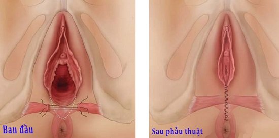 May thẩm mĩ vùng kín có đau không ? Có nên thẩm mỹ vùng kín?