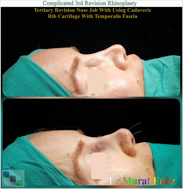 Complicated 3rd Revision Rhinoplasty - Tertiary Revision Nose Job With Using Cadaveric Rib Cartilage With Temporalis Fascia