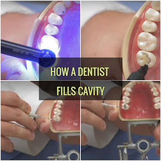 This Is The Chance If You Haven't Seen A Dentist Filling Cavity