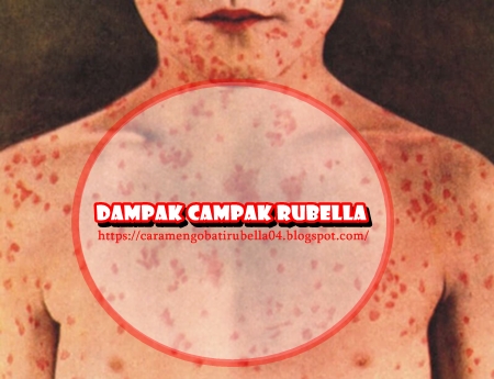 Dampak Campak Rubella