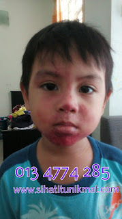 cara merawat impetigo