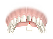 como pego corona dental