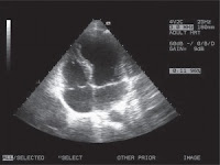 Takotsubo kardiomiopatija