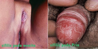 Obat Sipilis Luka Di Area Penis