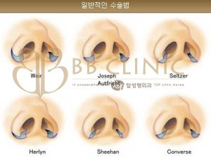 ตัดปีกจมูก ลดขนาดรูจมูก Nose Surgery