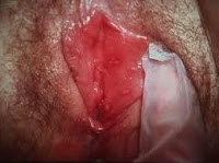 herpes vulvar