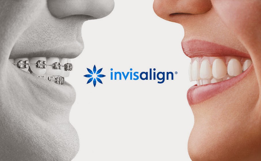 invisalign-vs-braquets-braces-aligner-alineadores_smile_sonrisa-ortodoncia-orthodont-teeth-dientes-dental
