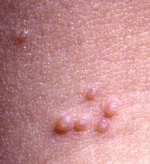 is molluscum contagiosum molluscum contagiosum is a skin infection 
