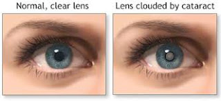 vision before and after cataract surgery