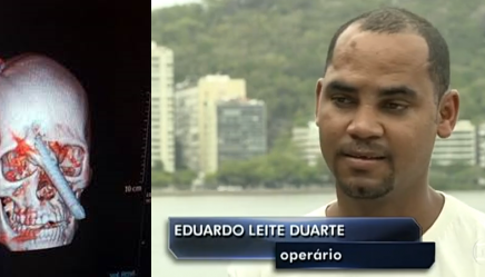 Milagre do operário com crânio perfurado por vergalhão no RJ é destaque no Globo Repórter-Assista