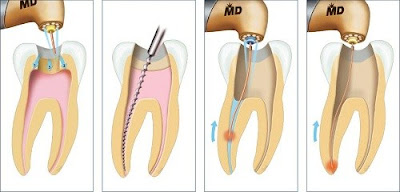 Lo lắng lấy tủy bọc răng sứ gây đau được giải bỏ-1