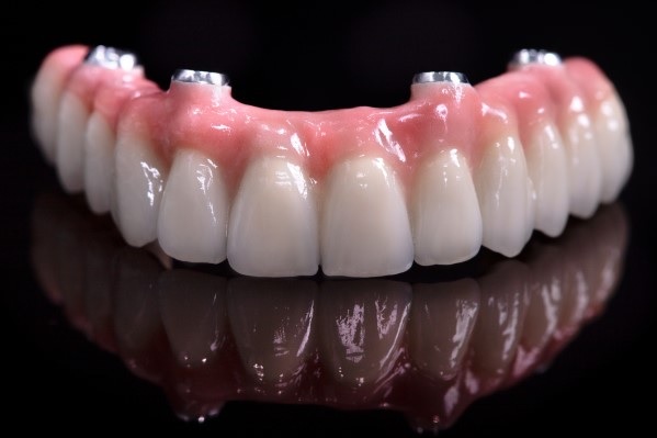 protesi dentali all on four - su quatro impianti dentali