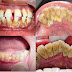 Cao răng cấp độ 3 có tác hại gì?