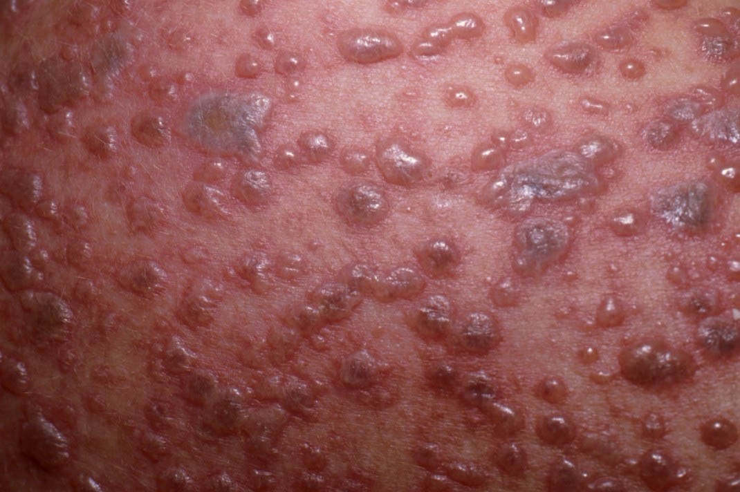 Penyebab Herpes  2016 Car Release Date