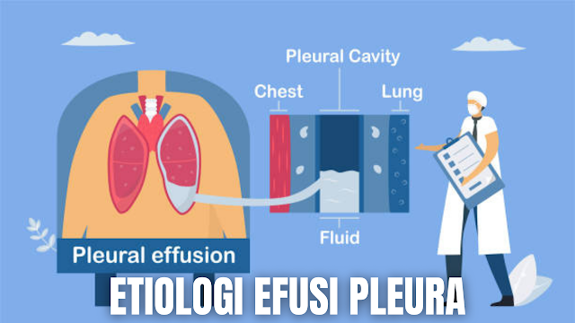 Etiologi Efusi Pleura Pada Manusia Menurut (Davey, 2002) etiologi dari efusi pleura adalah :  Efusi pleura transudat Gagal jantung Sindroma nifrotik Hipoalbuminemia Sirosis hepatis  Efusi pleura eksudat Pneumonia bakterialis Karsinoma Infark paru Pleuritis    Etiologi secara umum Efusi Pleura menurut (Mansjoer, 2001) adalah sebagai berikut :  Neoplasma seperti bronkogenik dan metastatik Kardiovaskuler seperti CHF, embolus pulmonas, dan perikarditis Penyakit pada abdomen seperti pankreatitis, asites, abses, sindroma meigs Infeksi yang disebabkan oleh bakteri, virus, jamur, mikrobakterial dan parasit Trauma Lain-lain seperti SLE, rheumatoid arthritis, sindroma nefrotik atau anemia    Nah itu dia bahasan dari Etiologi efusi pleura pada manusia, melalui bahasan di atas bisa diketahui mengenai Etiologi efusi pleura pada manusia. Mungkin hanya itu yang bisa disampaikan di dalam artikel ini, mohon maaf bila terjadi kesalahan di dalam penulisan, dan terimakasih telah membaca artikel ini."God Bless and Protect Us"